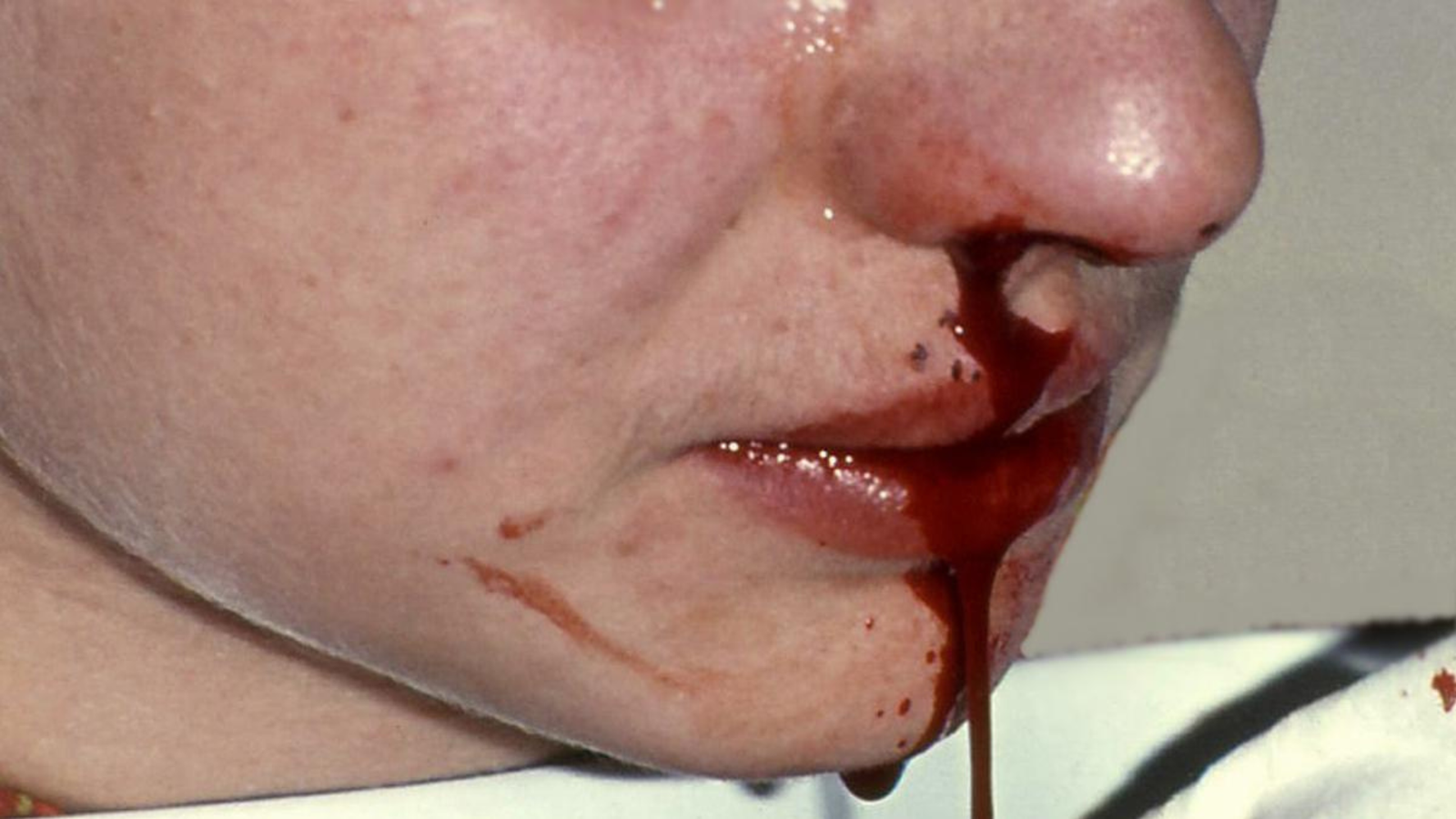 Nosebleeds: Causes, Symptoms and What to Know