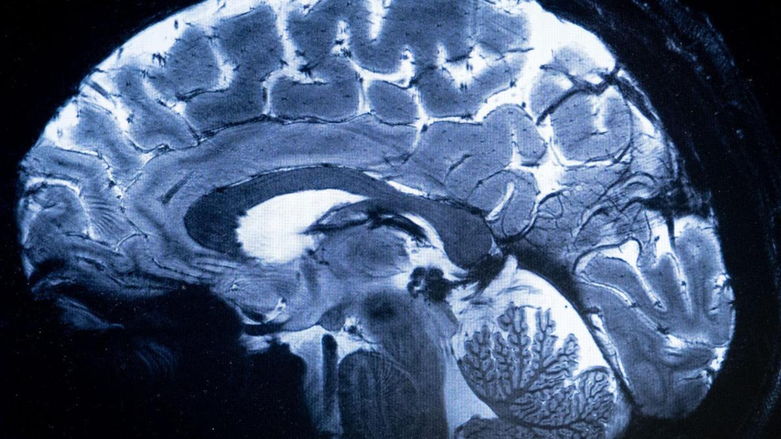 Alzheimer’s Blood Tests: What Can They Really Tell Us?