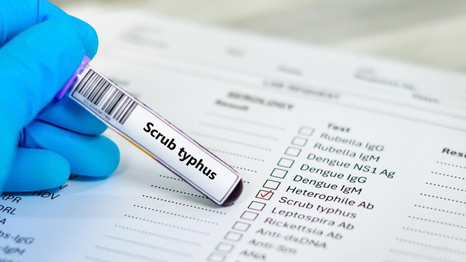 What Is Scrub Typhus? Symptoms, Causes and Treatment
