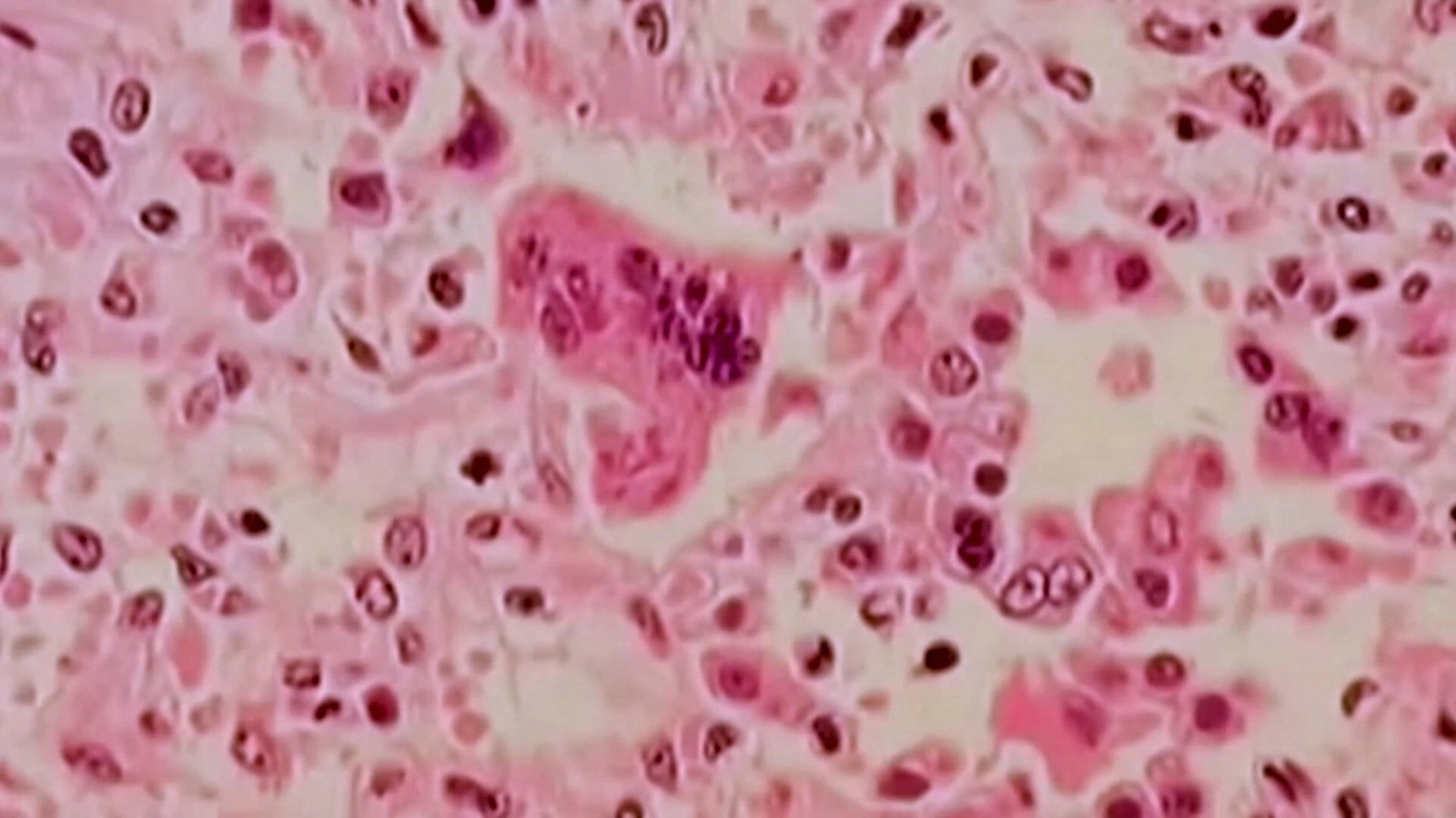 Measles Exposure Warning Issued for Illinois Restaurant