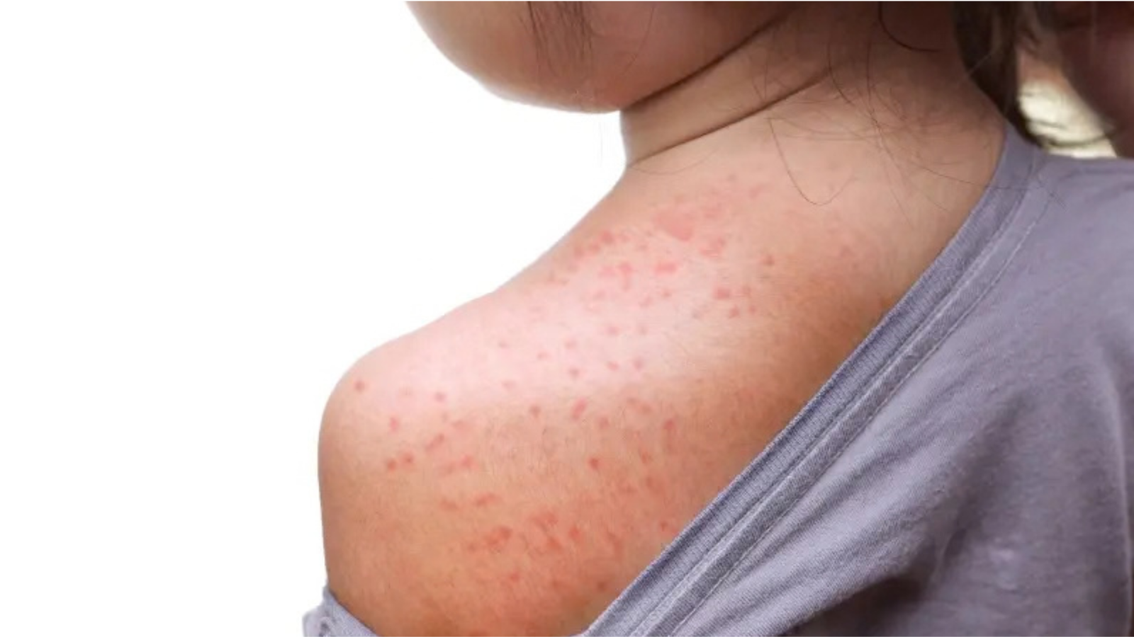 Pennsylvania Measles Outbreak Raises Concern Over Rare Cases