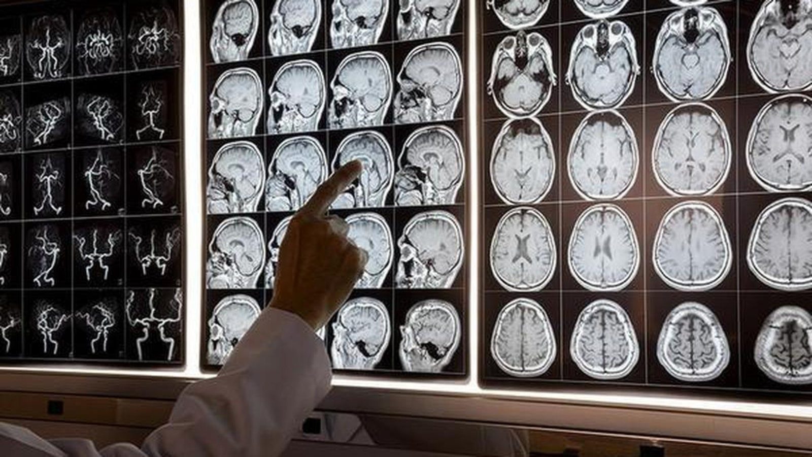 Brain Fog: When Forgetfulness May Need Investigation