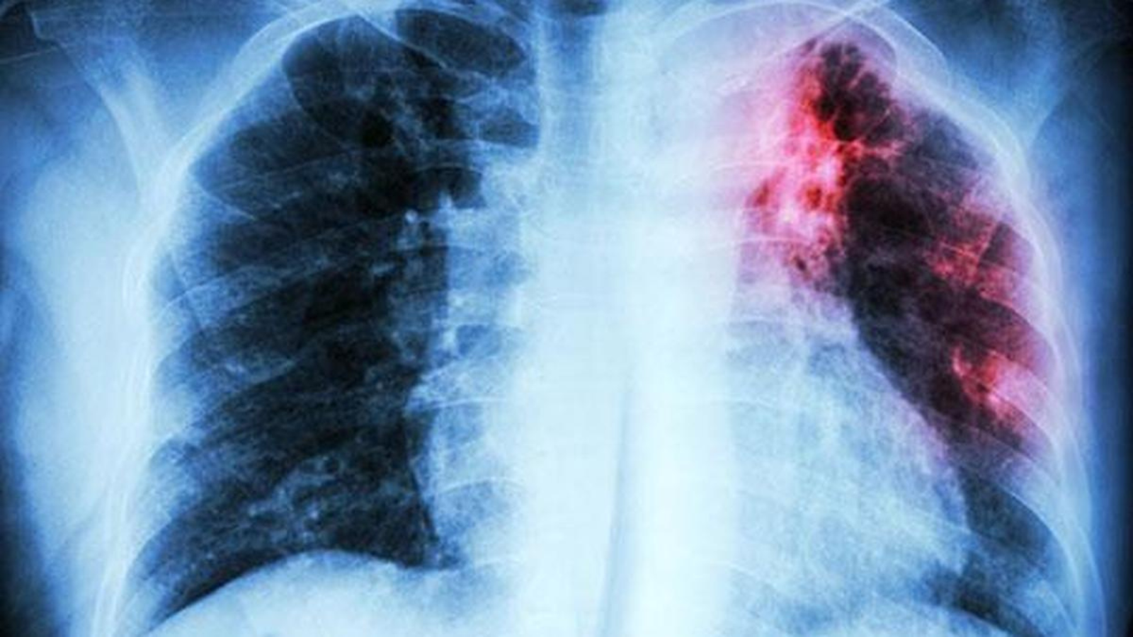TB Preventive Treatment Protection May Wane After One Year