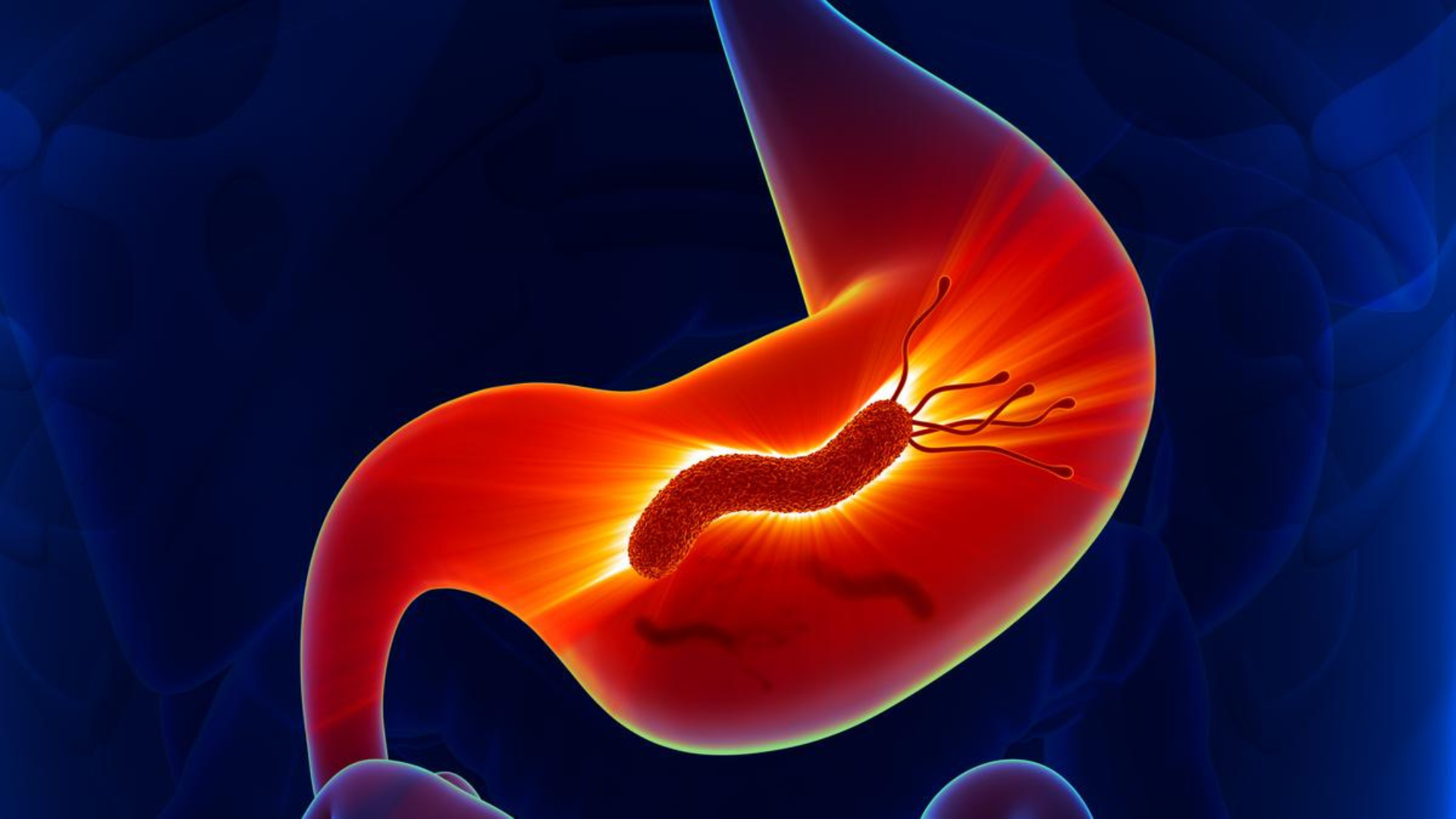 H. pylori Eradication May Help Prevent Gastric Cancer